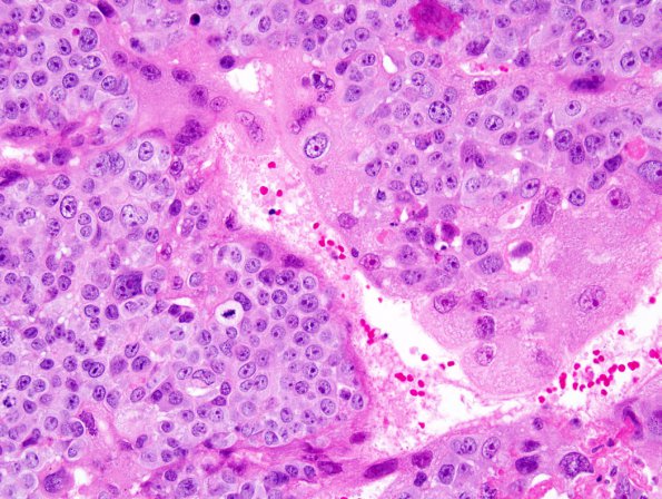 1B5 Choriocarcinoma (Case 1) 3