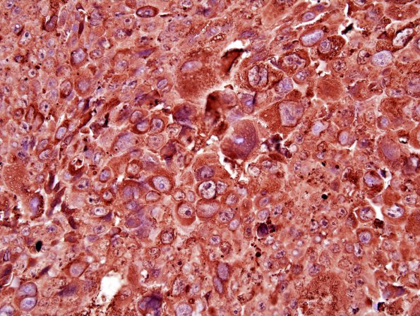 1C1 Choriocarcinoma (Case 1) B-HCG 1.