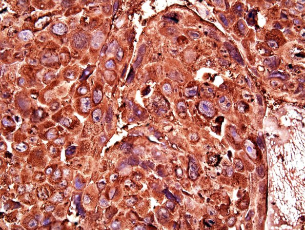 1C2 Choriocarcinoma (Case 1) B-HCG 3