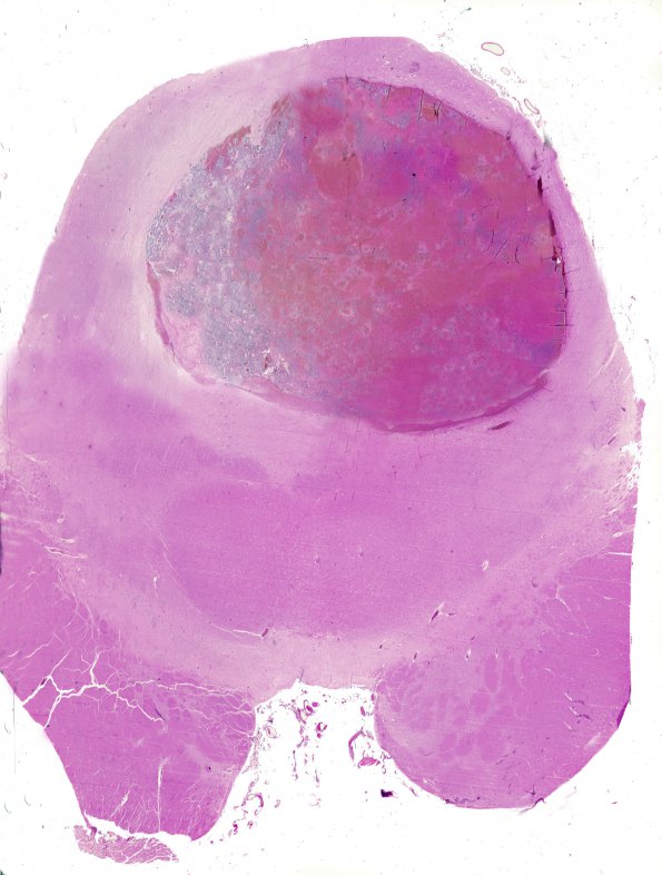 2A1 Choriocarcinoma, Pineal (Case 2) b