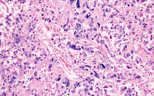 2A4 Choriocarcinoma, Pineal (Case 2) H&E 20X 3