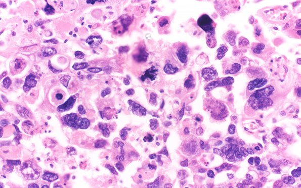 2A5 Choriocarcinoma, Pineal (Case 2) H&E 40X 1