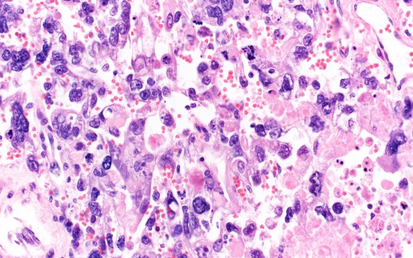 2A6 Choriocarcinoma, Pineal (Case 2) H&E 40X 2