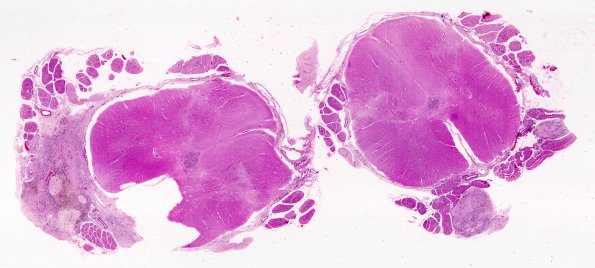 2B1 Choriocarcinoma, Pineal (Case 2) H&E WM