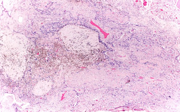 2B2 Choriocarcinoma, Pineal (Case 2) H&E 4X