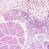 2B3 Choriocarcinoma, Pineal (Case 2) H&E 5