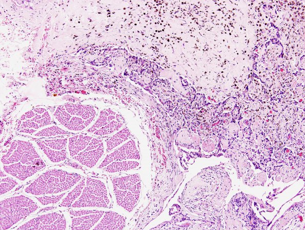 2B3 Choriocarcinoma, Pineal (Case 2) H&E 5