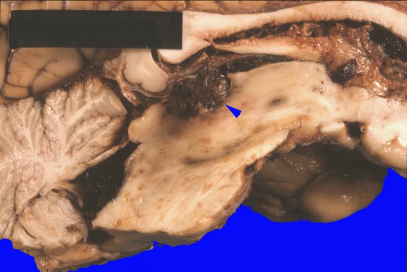 3 Choriocarcinoma, pineal origin (Case 3) A