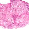 10A1 Germinoma, reaction (Case 10) Pineal H&E 10X