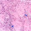 10A3 Germinoma, reaction (Case 10) Pineal H&E 20X copy