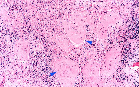 10A3 Germinoma, reaction (Case 10) Pineal H&E 20X copy