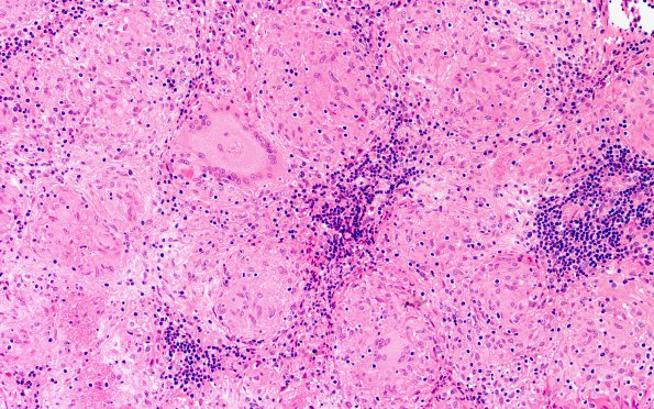 10A6 Germinoma, reaction (Case 10) Pineal H&E 20X