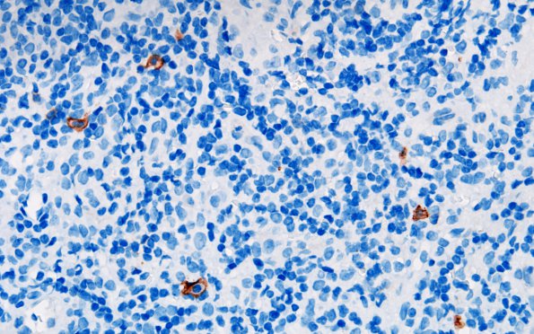 10B2 Germinoma, reaction (Case 10) Pineal c-kit 60X 2