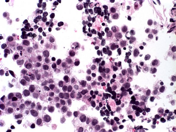 12A1 Germinoma (Case 12) 1