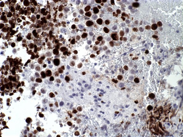 12C1 Germinoma (Case 12) MIB 2