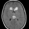 15A1 Germinoma, pineal with seeding (Case 15) T1W - Copy