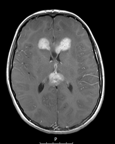 15A1 Germinoma, pineal with seeding (Case 15) T1W - Copy