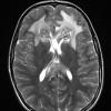 15A2 Germinoma, pineal with seeding (Case 15) T2W - Copy