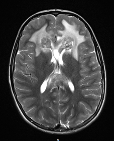 15A2 Germinoma, pineal with seeding (Case 15) T2W - Copy