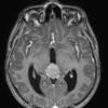 16A1 Germinoma (Case 16) T1 MPHRAGE w Contrast 2 - Copy