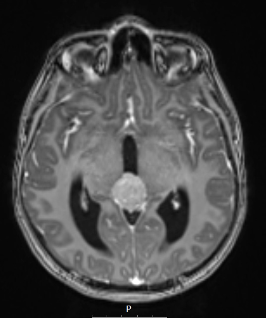 16A1 Germinoma (Case 16) T1 MPHRAGE w Contrast 2 - Copy