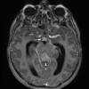 16A2 Germinoma (Case 16) T1 MPHRAGE w Contrast Axial - Copy