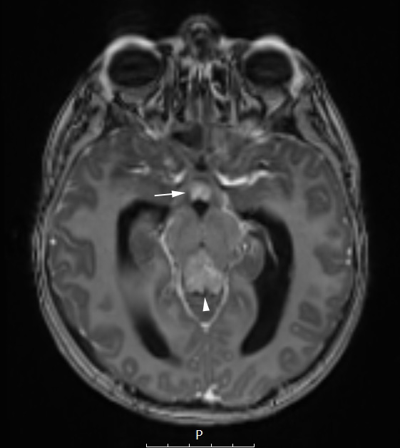 16A2 Germinoma (Case 16) T1 MPHRAGE w Contrast Axial - Copy