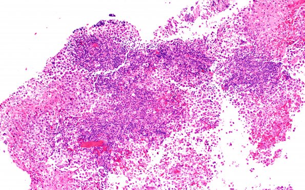 16B1 Germinoma, pineal & Suprasellar (Case 16) H&E 10X