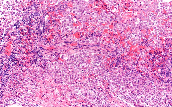 16B5 Germinoma, pineal & Suprasellar (Case 16) H&E 20X 2