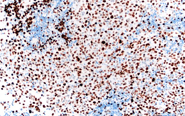 16F Germinoma, pineal & Suprasellar (Case 16) Ki67 20X 2