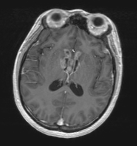 17A3 Germinoma, pineal (Case 17) T1W - Copy
