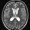 17A4 Germinoma, pineal (Case 17) T2 2 - Copy