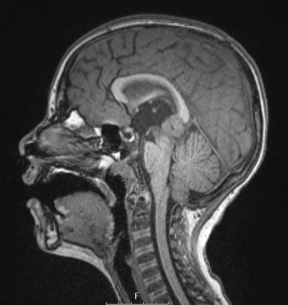 18A1 (Case 18) T1 SAG - Copy