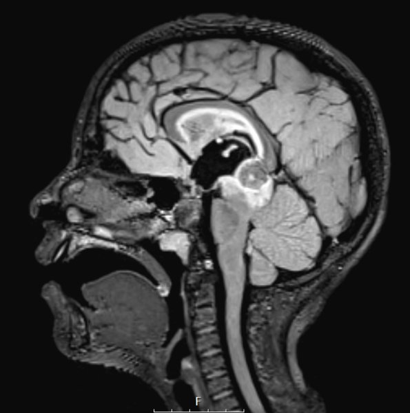 18A3 (Case 18) T2W SAG - Copy