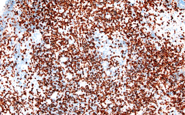 18E1 Germinoma pineal (Case 18) CD3 20X