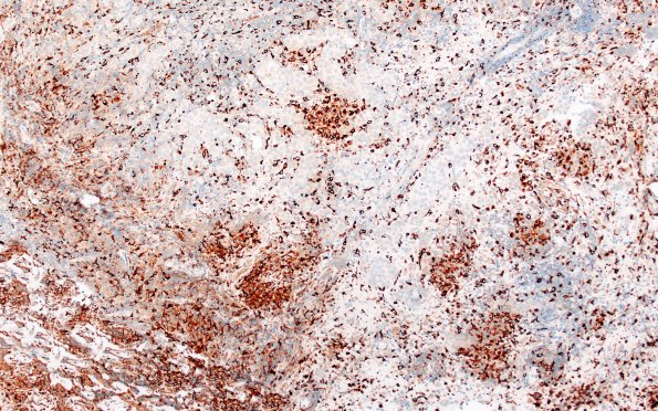 18G1 Germinoma pineal (Case 18) CD68 10X