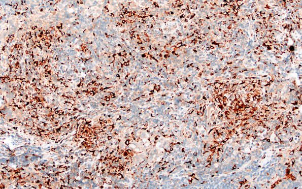 18G2 Germinoma pineal (Case 18) CD68 20X