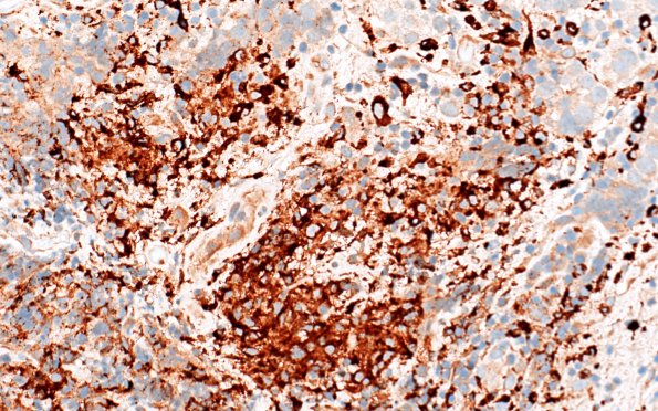 18G3 Germinoma pineal (Case 18) CD68 40X