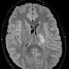 1A1 Germinoma (Case 1) FLAIR - Copy