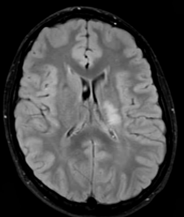 1A1 Germinoma (Case 1) FLAIR - Copy