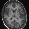 1A2 Germinoma (Case 1) T1 no C - Copy