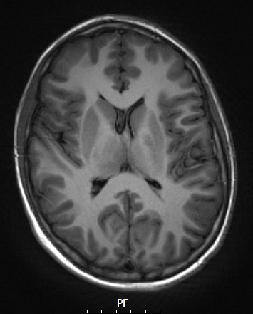 1A2 Germinoma (Case 1) T1 no C - Copy