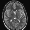 1A3 Germinoma (Case 1) T2 no C - Copy