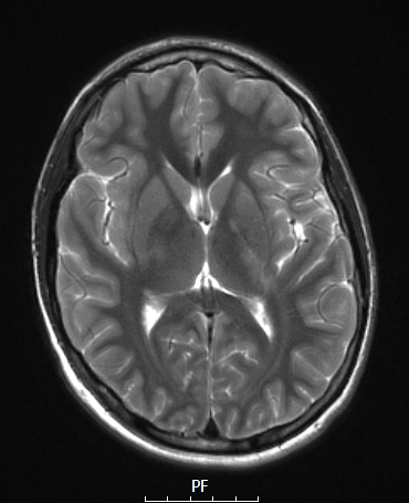 1A3 Germinoma (Case 1) T2 no C - Copy