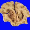 1B1 Germinoma (Case 1) Gross 5