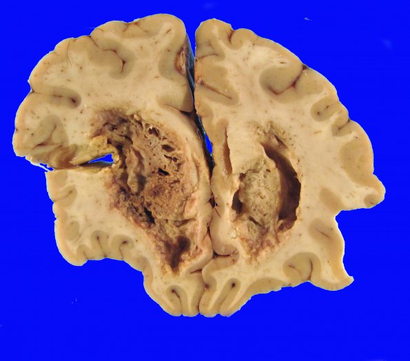 1B1 Germinoma (Case 1) Gross 5