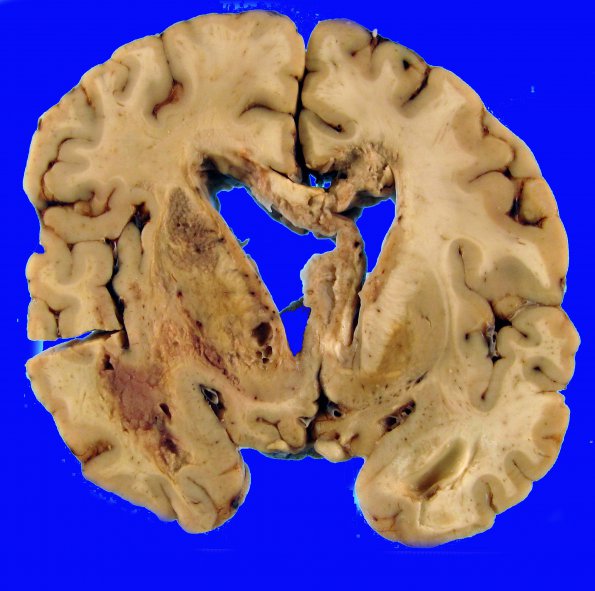 1B2 Germinoma (Case 1) Gross 3