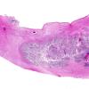 1C1 Germinoma (Case 1) N21 H&E whole mount