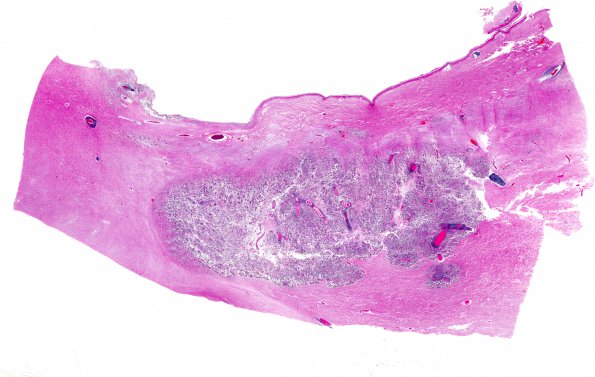 1C1 Germinoma (Case 1) N21 H&E whole mount