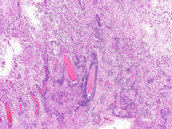 1C2 Germinoma (Case 1) H&E 7a